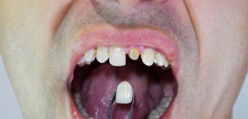 A failing/cracked tooth needing extraction